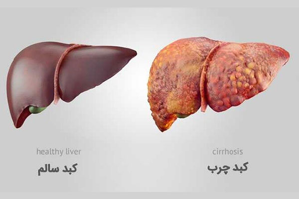 بیماری کبد چرب